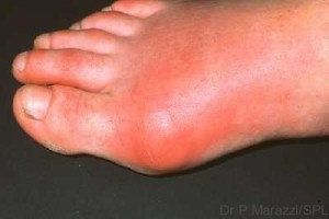 Gout. Close-up of the foot of a patient with gout, showing an inflamed, reddened area around the joint at the base of the big toe. Gout is a type of arthritis (joint disease) caused by an excess- ive level of the waste product uric acid in the blood stream. Crystals of uric acid collect inside the fluid-filled space within a joint (often just in the toe joint, as in this case) causing inflam- mation and acute pain. Gout is sometimes associated with kidney disorders, such as kidney stones, and is far more common in men than women. Treatment includes anti-inflammatory drugs and drugs to lower the level of uric acid in the blood. Attacks of gout usually subside after a few days.
