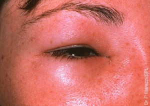 Bee sting. Swelling round the eye due to a bee sting. Bee stings can cause pain, redness and swelling for up to 48 hours. This is due to sensitization of the immune system to bee venom on a previous occasion. The venom is recognised as a foreign substance and triggers an inappropriately vigorous inflammatory response, mediated by body substances such as histamine. This kind of hyper- sensitive reaction is called an anaphylactic response, the commonest type of allergic reaction. If the hypersensitivity is extreme, the victim may die of shock unless adrenaline is administered. Treatment for stings includes removing the sting, washing the wound and taking painkillers.